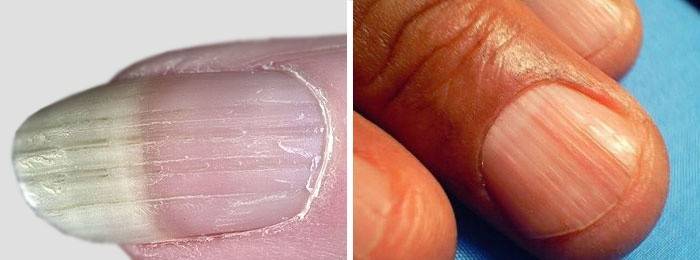 Поражение ногтевых пластин: отличительные черты онихорексиса