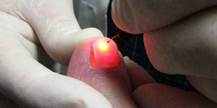 Процедура лазерного удаления вросшего ногтя