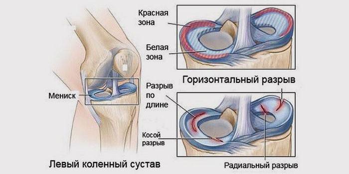 Травмы мениска коленного сустава