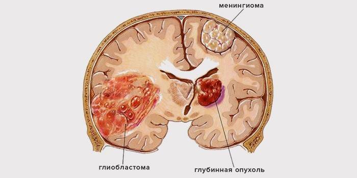 Глиобластома головного мозга