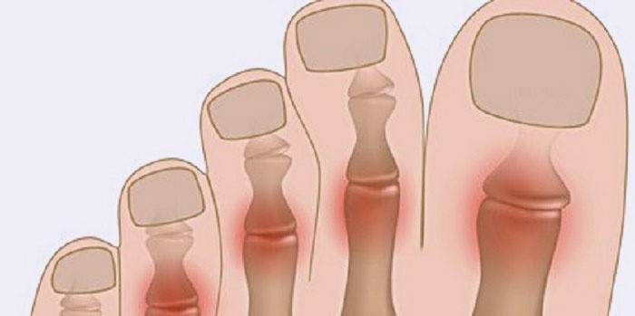 Артроз: болит большой палец ноги