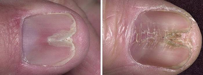 Признаки срединной каналообразной ногтевой патологии