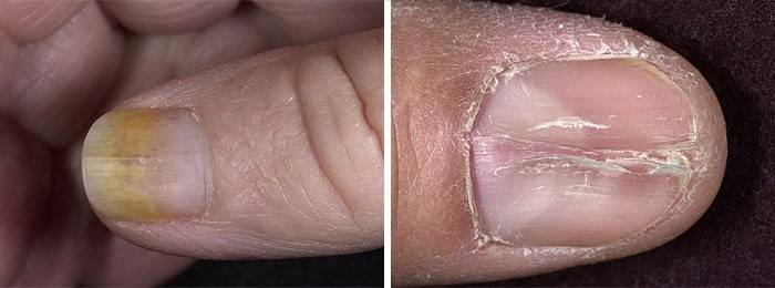 Сопутствующие факторы развития ногтевой дистрофии у взрослых
