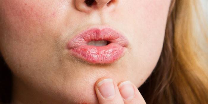 Сухость губ у женщины