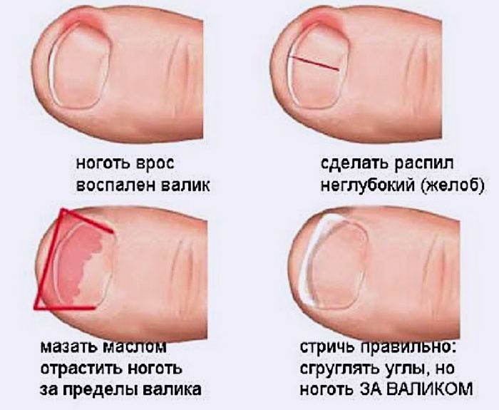 Способы лечения вросшего ногтя на ногах