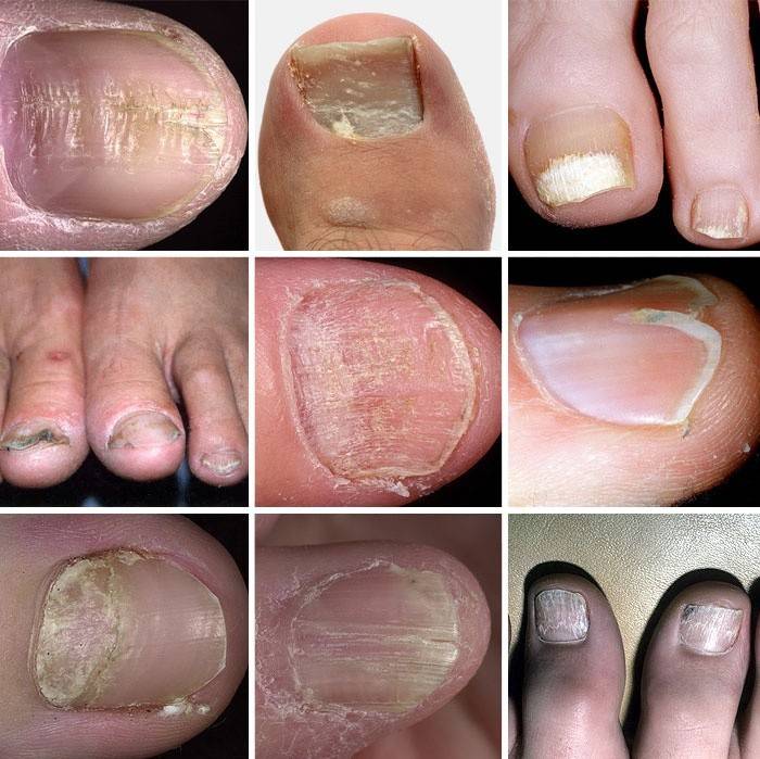 Разнообразные варианты дистрофии ногтевой пластины