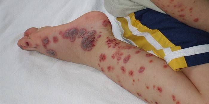 Аутоиммунное заболевание крови - тромбоцитопеническая пурпура