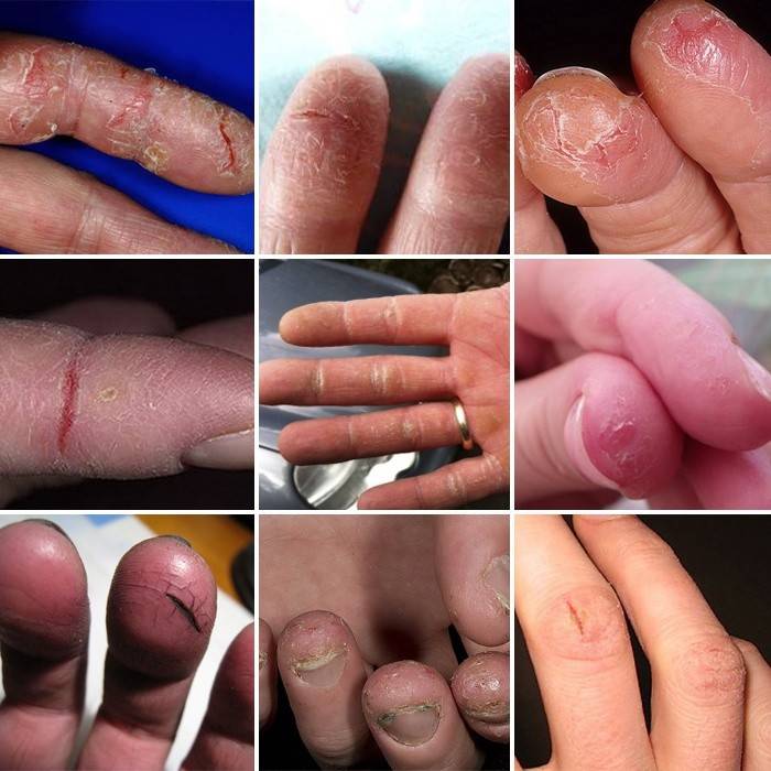 как выглядят трещины на пальцах
