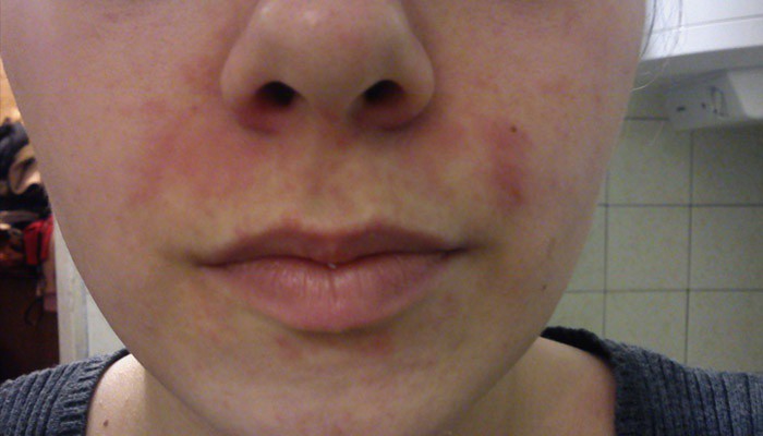 Себорейный дерматит на лице лечение