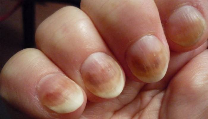 Признаки заболевания ногтей на руках