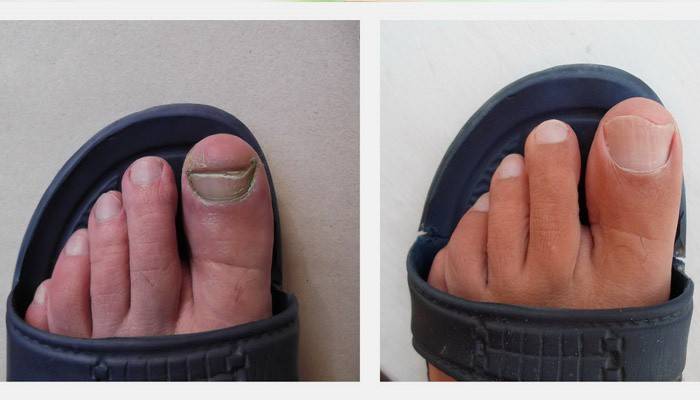 Ногти до и после лечения