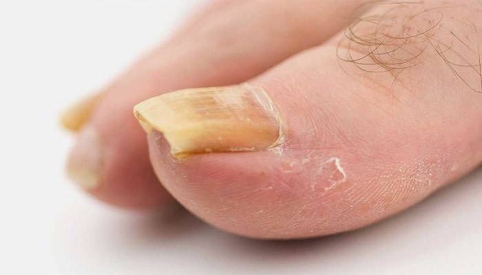 Признаки псориаза ногтей на ногах