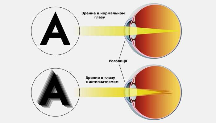 Нормальное зрение и в глазу с астигматизмом