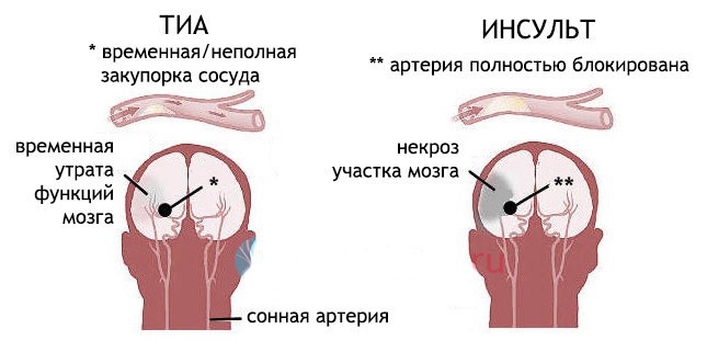 Отличие ТИА и инсульта