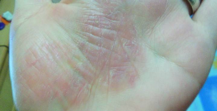Шелушение кожи на ладонях рук