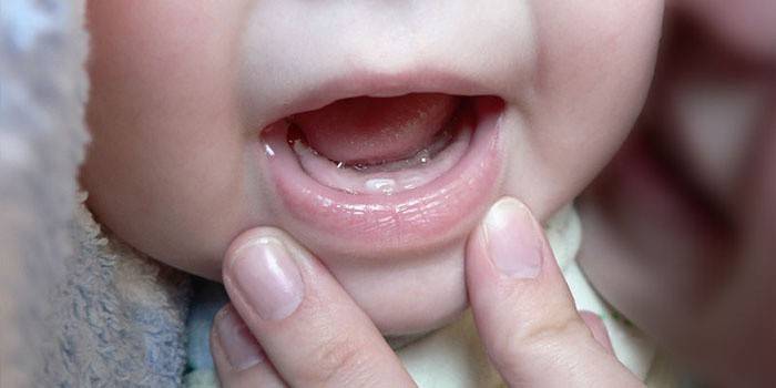 Прорезывание первого зуба у грудничка