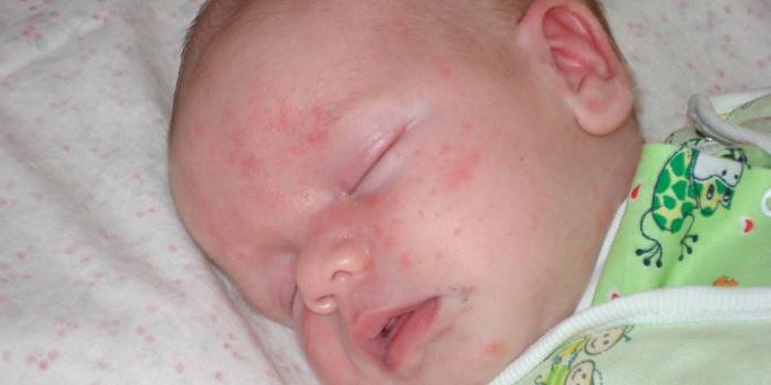 Проявления аллергии у ребенка