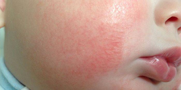 Сыпь на лице как признак инфекции