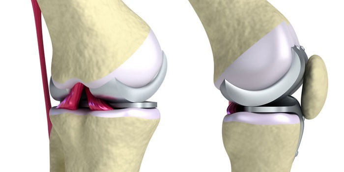 Изображение - Как лечить деформирующий артроз коленного сустава 1673652-5ui6i