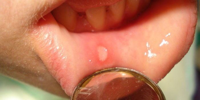 Проявление герпеса на слизистой рта у ребенка