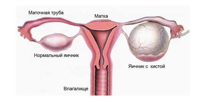 Фолликулярная киста яичника симптомы и лечение