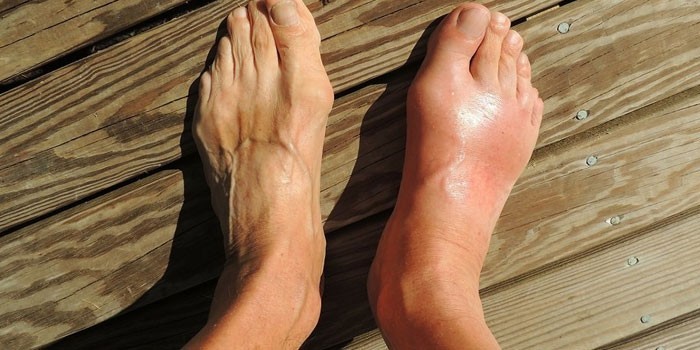 Изображение - Чем лечить суставы ног в домашних условиях 2384357-tekst