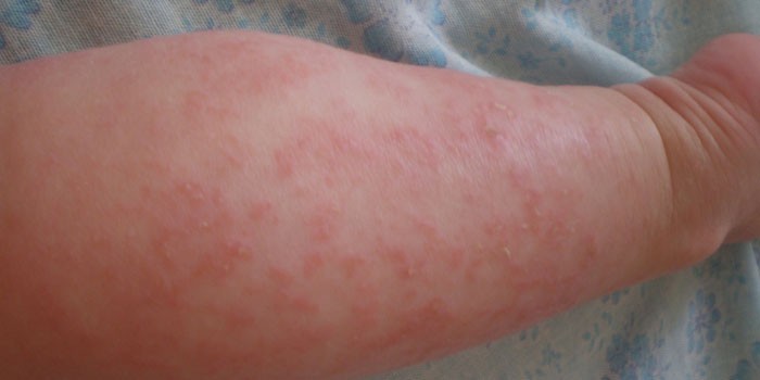 Аллергический дерматит на ногах