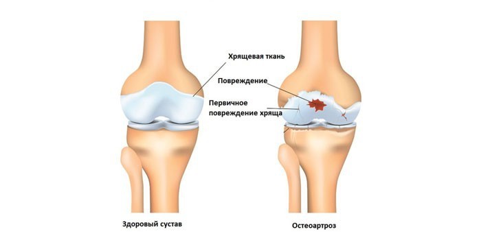 Что такое остеоартроз коленного сустава