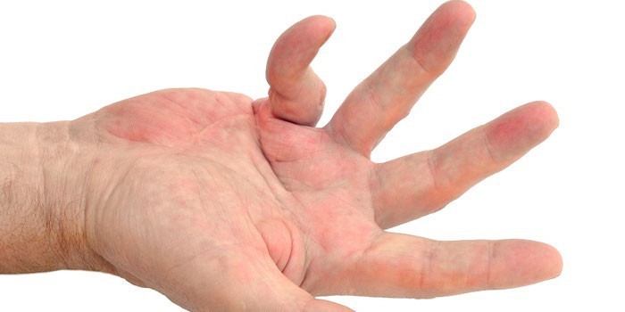 Контрактура пальцев рук лечение