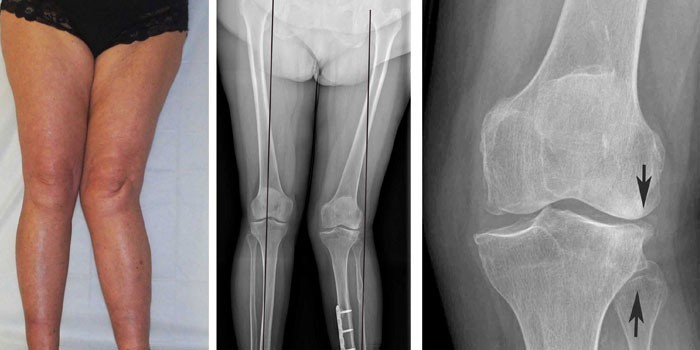 Изображение - Схема лечения артроза коленного сустава 2 степени 5761264-lm