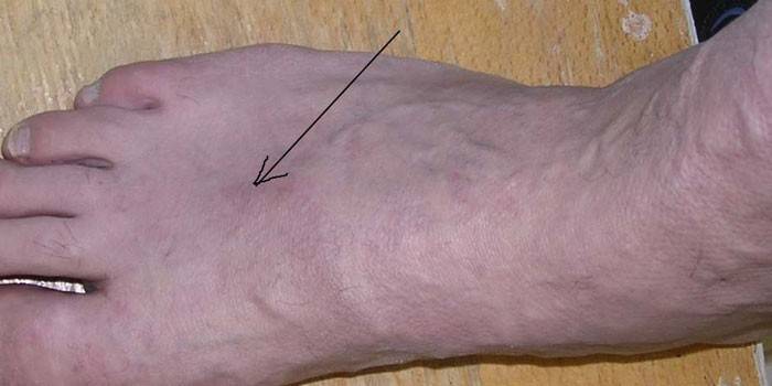 Как определить тромб в ноге признаки фото