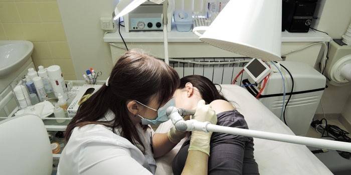 Косметолог проводит лазерное удаление невуса у пациентки