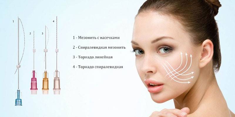 Виды мезонитей