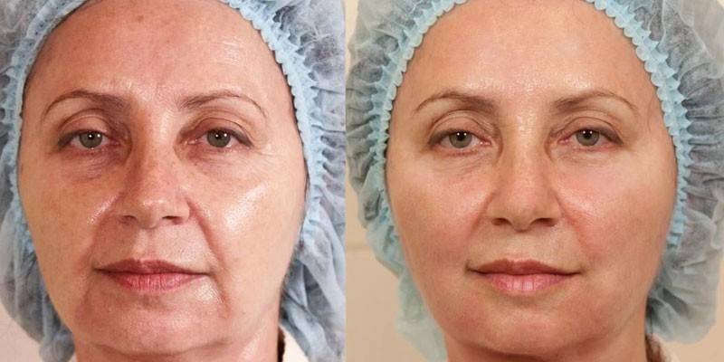 Фото женщины до и после тредлифтинга
