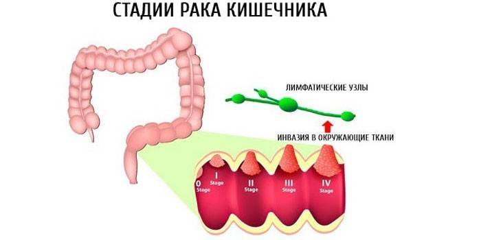 Стадии рака кишечника