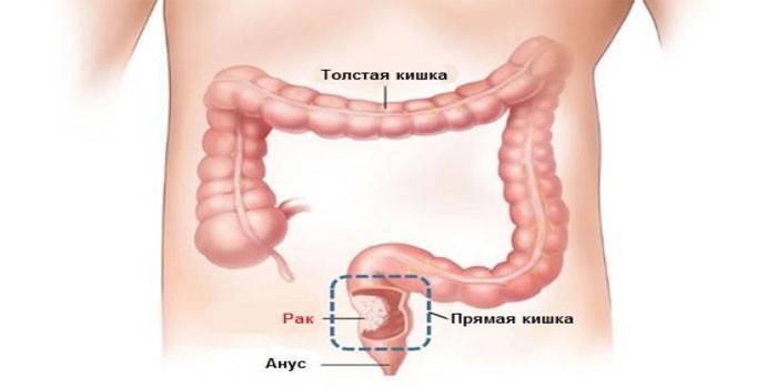 Рак прямой кишки