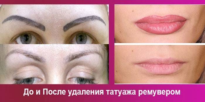 Плюсы и минусы удаления татуажа ремувером