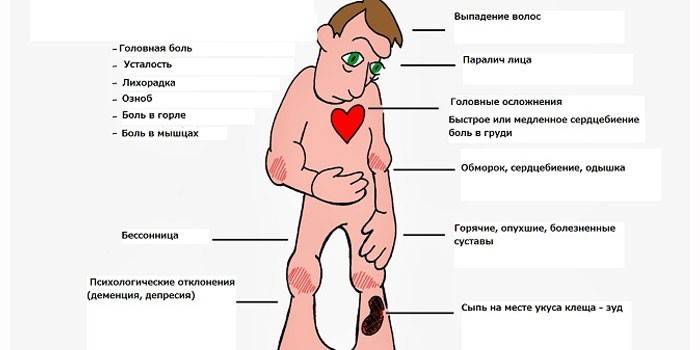 Симптомы болезни Лайма