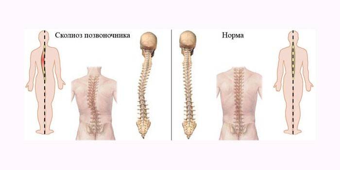 Искривление позвоночника и норма