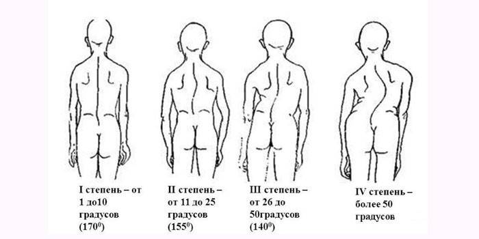 Степени сколиоза