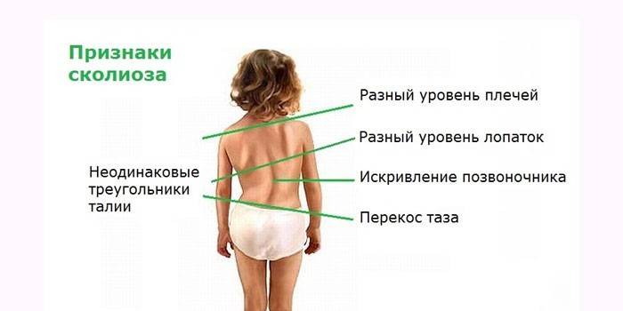 Признаки сколиоза
