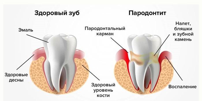 Здоровый зуб и больной пародонтитом