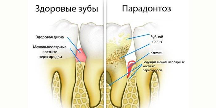Проявления пародонтоза
