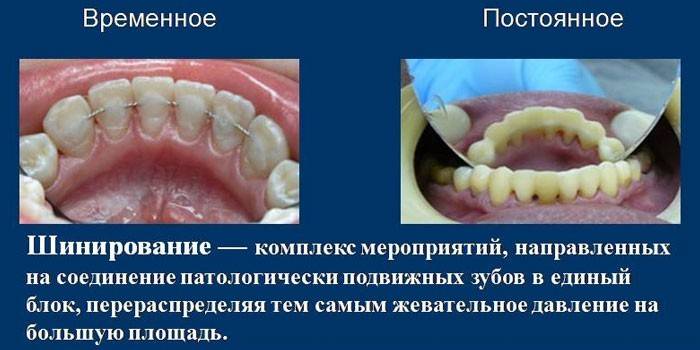 Временное и постоянное шинирование