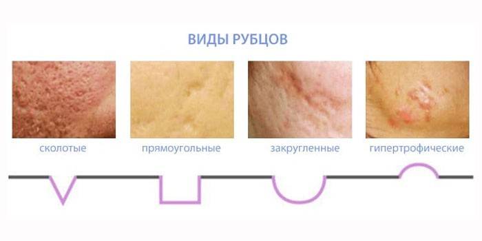 Виды рубцов
