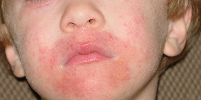 Пероральный дерматит на лице у ребенка