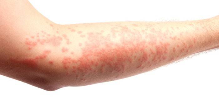 Аллергическая сыпь на руке