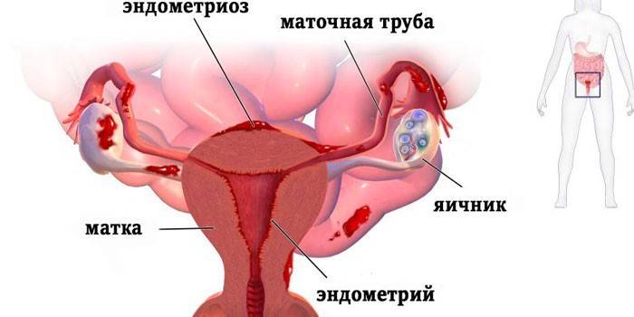 Схема эндометриоза матки