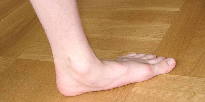 Плоскостопие ноги