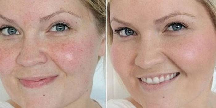 Кожа на лице женщины до и после чистки у косметолога